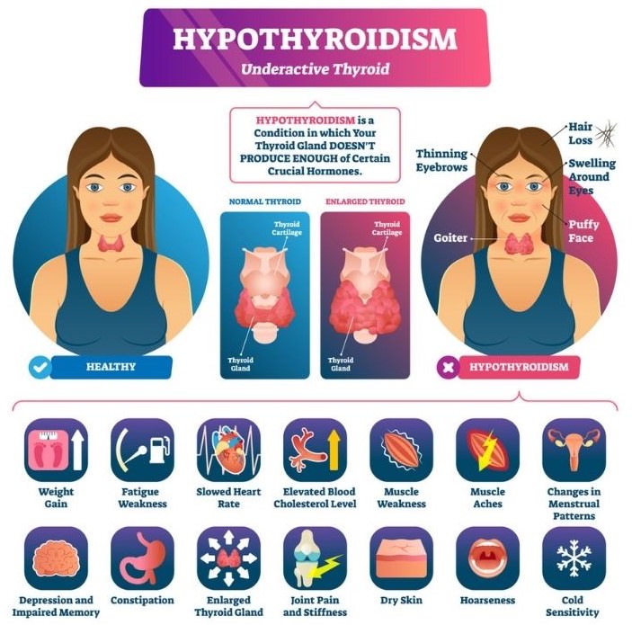 What are Under active Thyroid Symptom ?